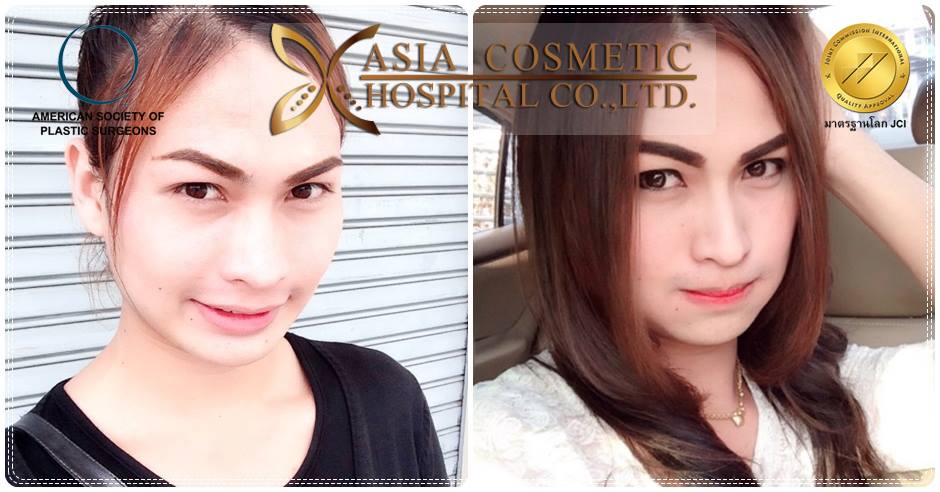  เสริมจมูกสวยๆ