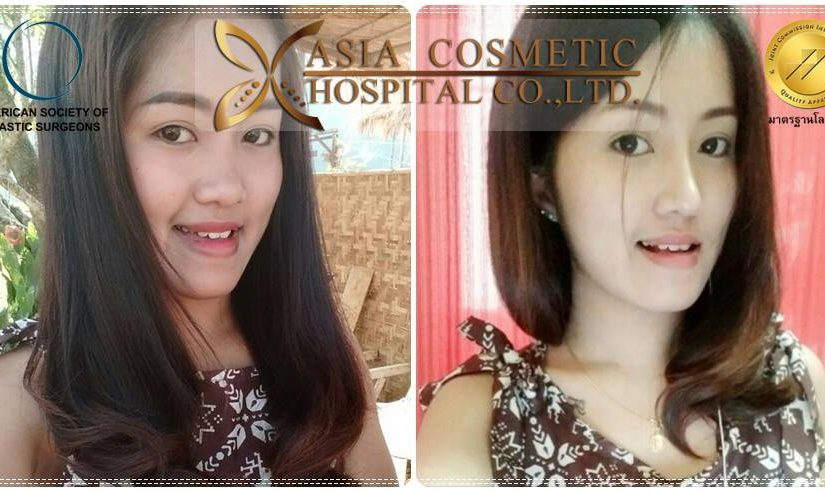 รีวิวเสริมจมูก