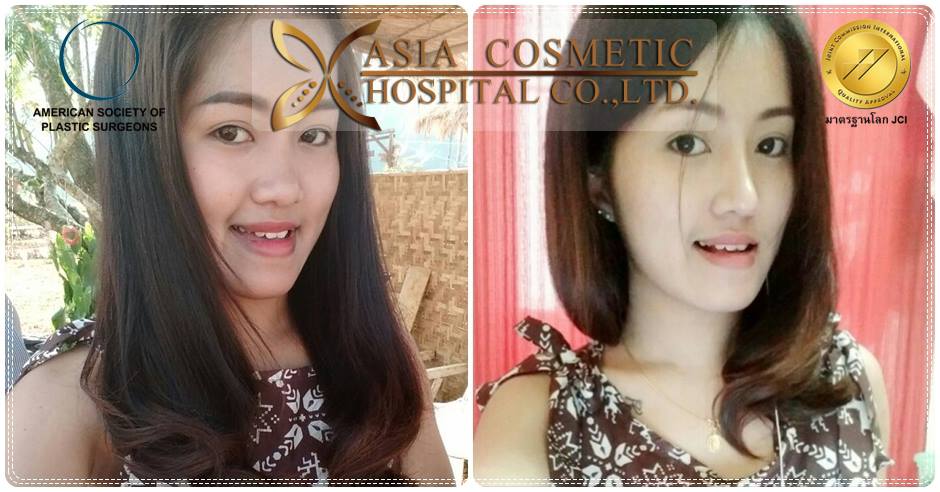 รีวิวเสริมจมูก