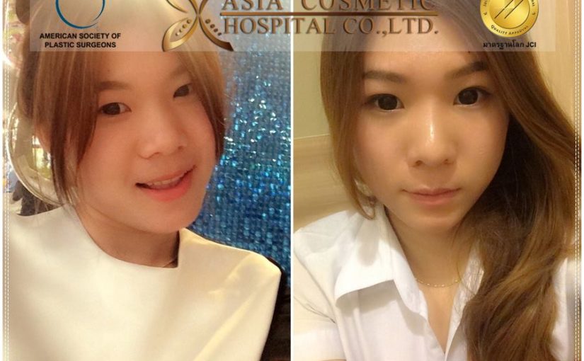 เสริมจมูกสวยๆ