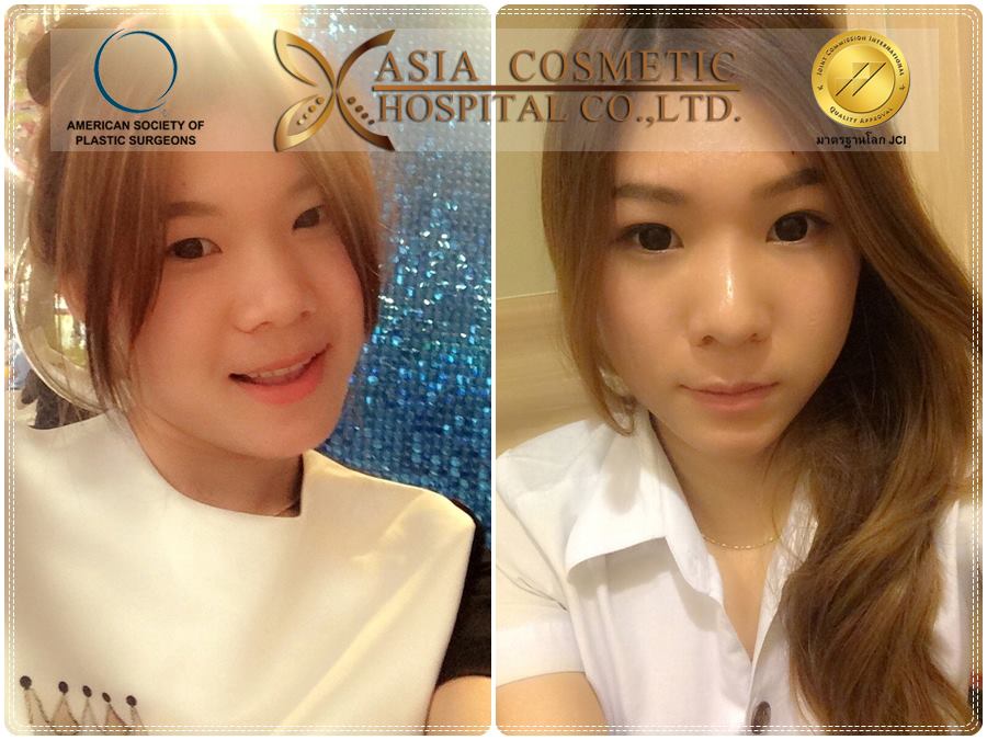 เสริมจมูกสวยๆ