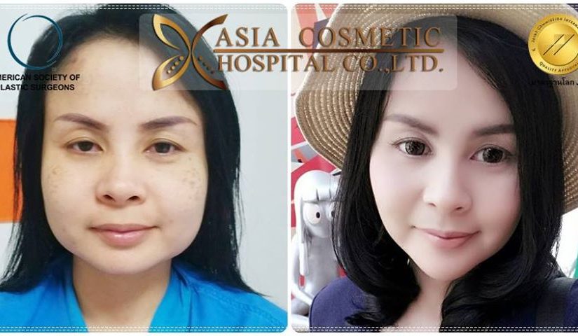 ยุบโหนกแก้ม