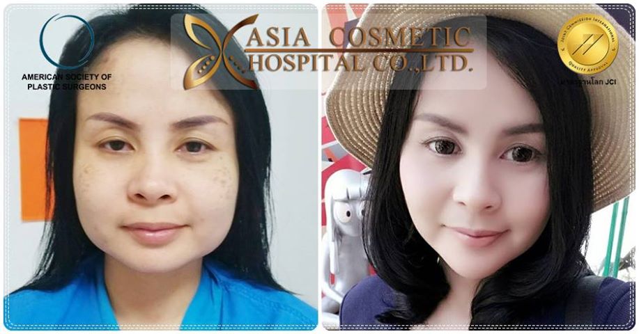 ยุบโหนกแก้ม