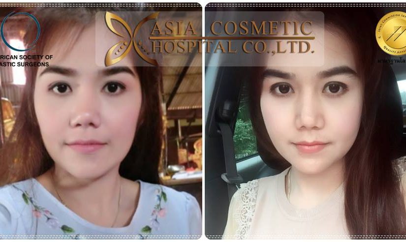 ยุบโหนกแก้ม