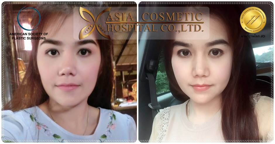 ยุบโหนกแก้ม