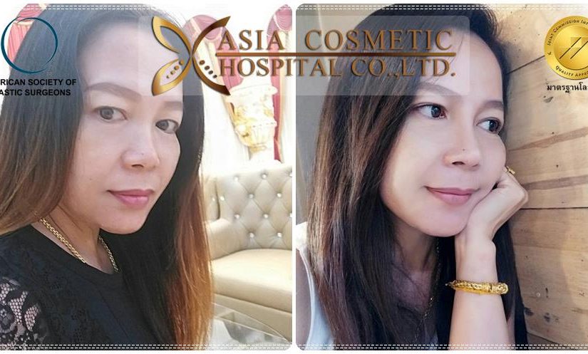 ศัลยกรรมจมูก