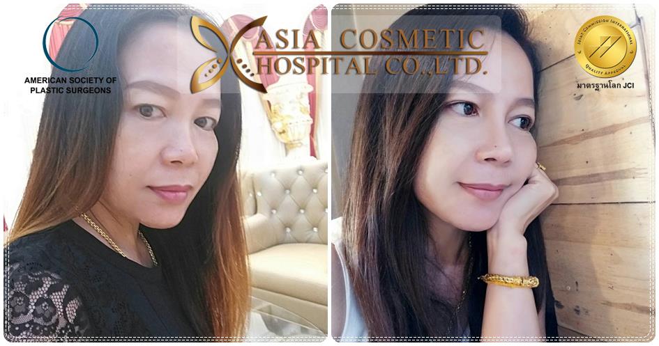 ศัลยกรรมจมูก