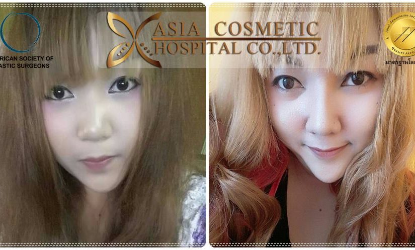 เสริมจมูก