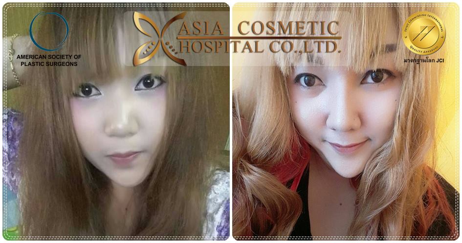 เสริมจมูก