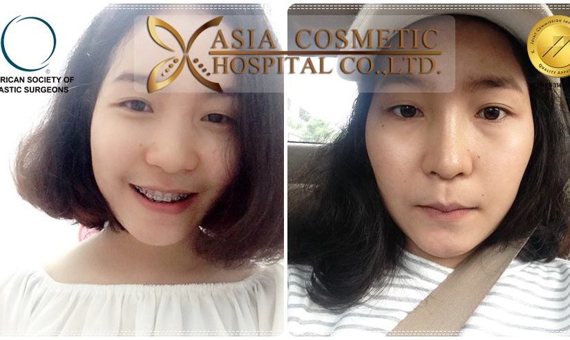 ศัลยกรรมจมูก AsiaHospital