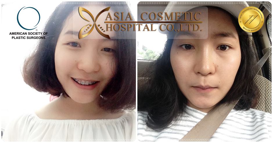 ศัลยกรรมจมูก AsiaHospital