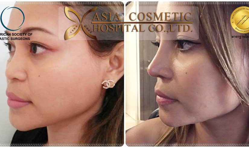 เสริมจมูกสวย
