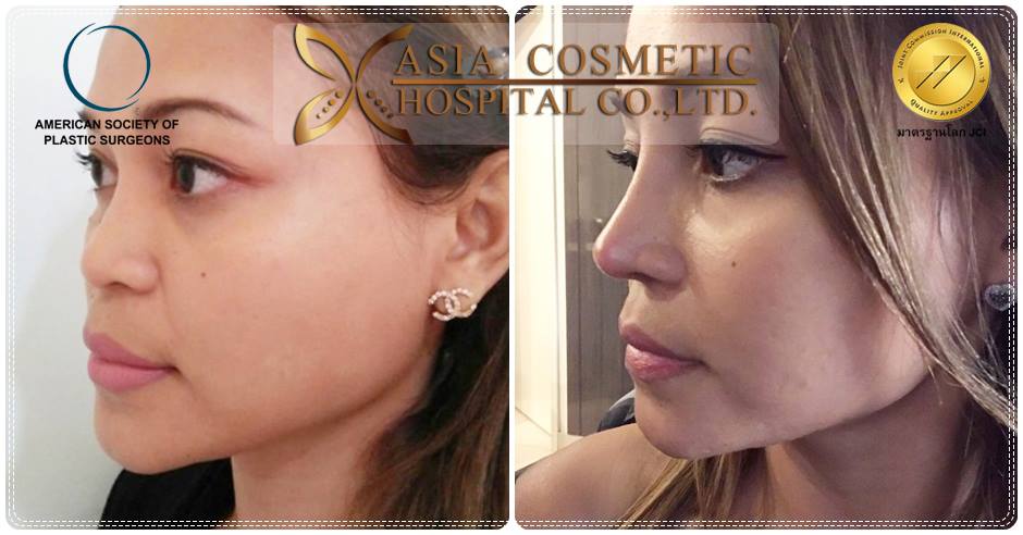 เสริมจมูกสวย