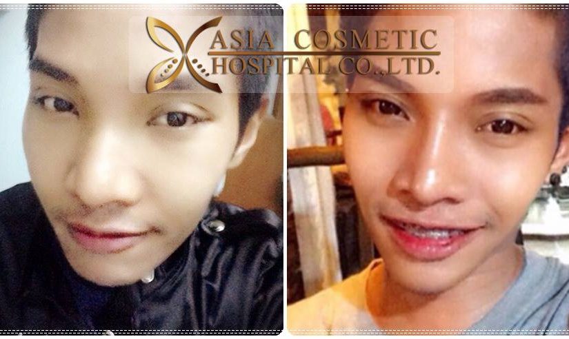 เสริมจมูก