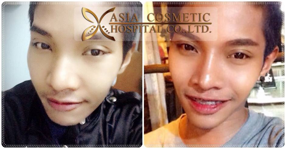 เสริมจมูก