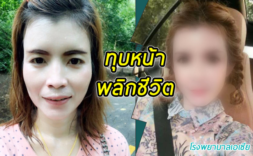 ทุบโหนกแก้ม