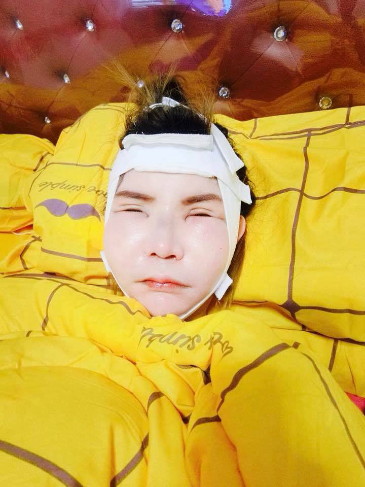 หลังผ่าตัดโหนกแก้ม