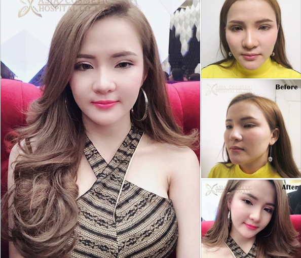 ยุบโหนก