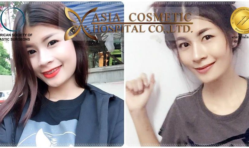 เสริมจมูก