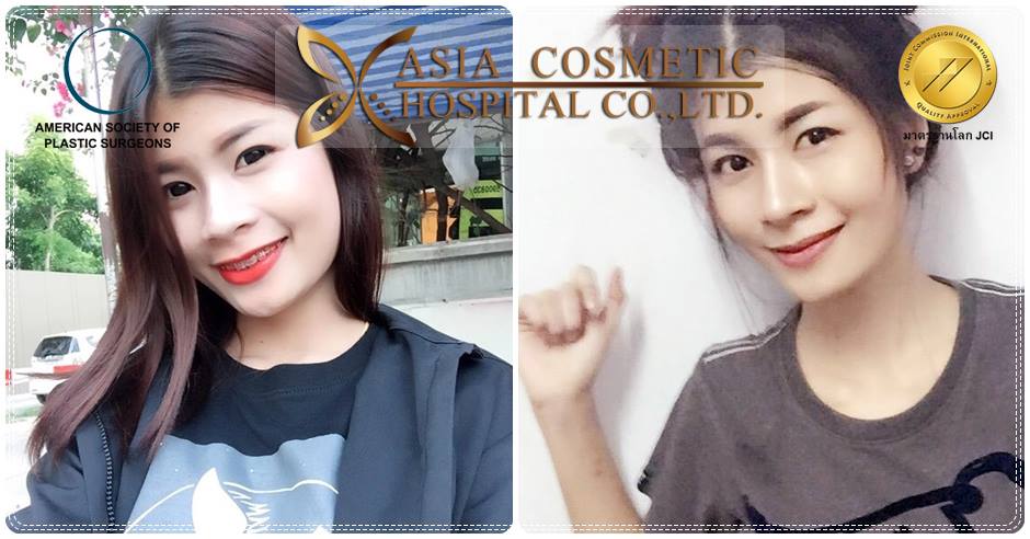 เสริมจมูก