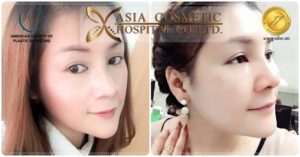 รีวิวแก้จมูก