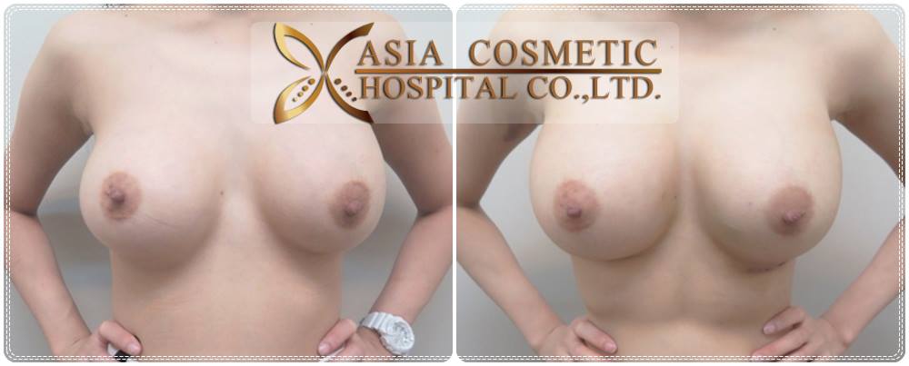 รีวิวแก้ไขหน้าอก