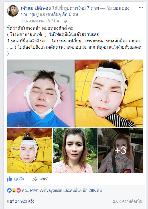ยุบโหนกแก้ม