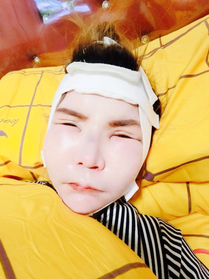 ทุบโหนกแก้ม