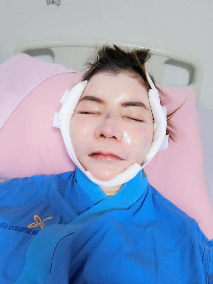 ลดโหนกแก้ม