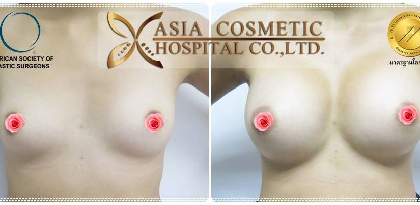 เสริมหน้าอก