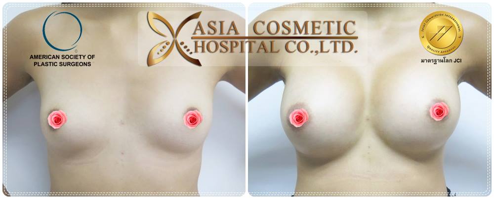เสริมหน้าอก
