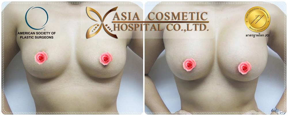 เสริมนม