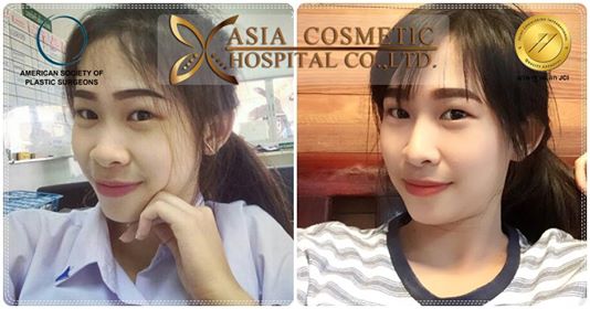 เสริมดั้ง