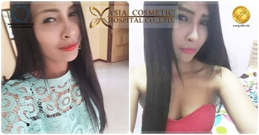 เสริมหน้าอก