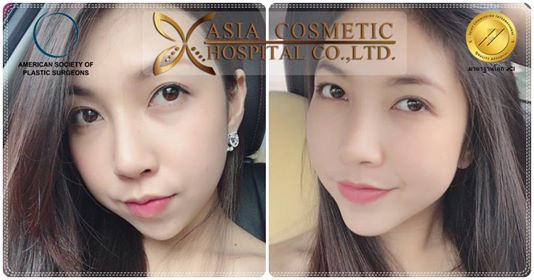 รีวิวเสริมคาง