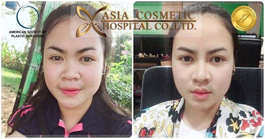 รีวิวเสริมจมูก หมอทนงศักดิ์