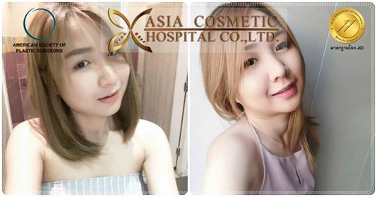 เสริมคาง