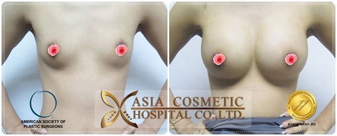 เสริมหน้าอก