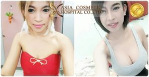 ทำหน้าอก 2019