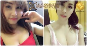 รีวิวทำหน้าอก 2019