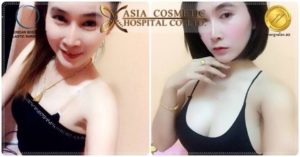 รีวิวเสริมหน้าอก 2019