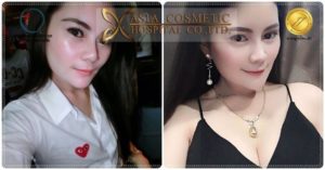 ศัลยกรรมหน้าอก 2019