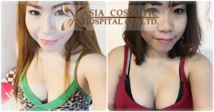 เสริมหน้าอก 2019