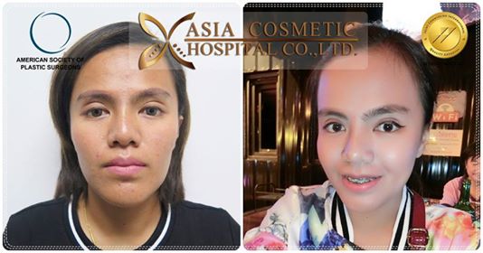 ยุบโหนกแก้ม หมอทนงศักดิ์